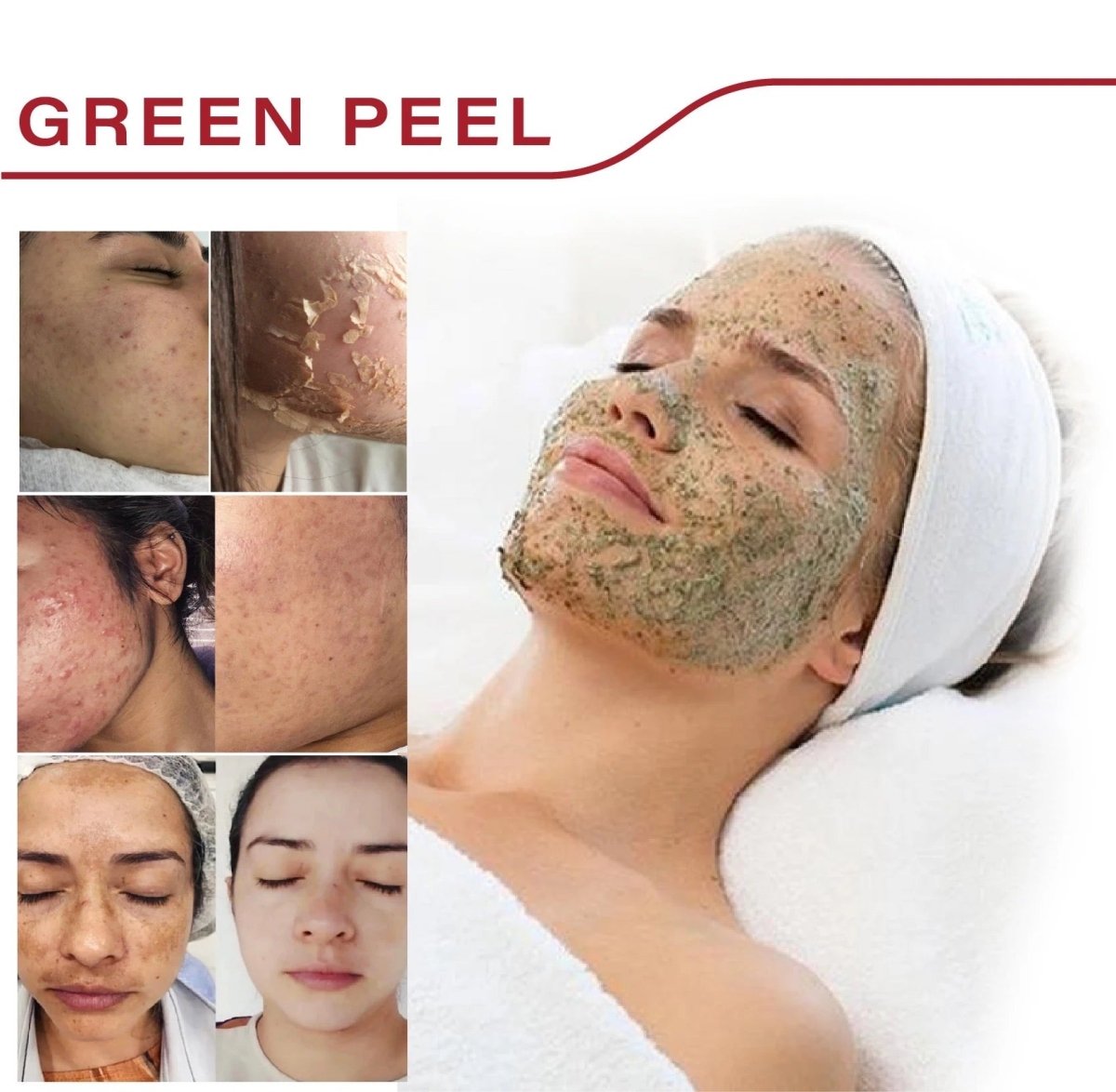 Algae Peel 20% Seaweed Peel Facial Treatment, 5ml + 100mg Canada