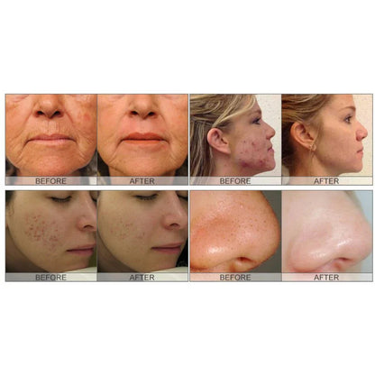 Advanced Hydro Dermabrasion Facial Machine, Model X13D